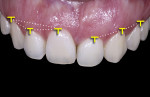 Fig 5. Intraoral photograph showing changed gingival contour.