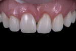 Fig 7.  Teeth after minimal wear and periodontal plastic surgery.