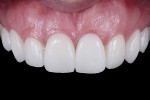 Fig 11.  Immediate result after cementation.