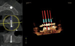 Figure 4  Diagnosis of edentulous maxilla and virtual placement of four dental implants in the maxillary arch using the Keystone Easyguide CT scanning software.