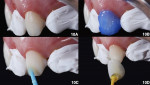 Fig 10.  Neighbouring teeth were protected with polytetrafluoroethylene tapes (10a); 37% phosphoric acid in enamel (10b); adhesive (10c); restoration positioned (10d).