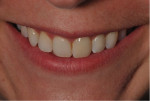 Fig 1. Preoperative view and esthetic evaluation showing discolored maxillary left central incisor.