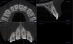 Fig 3. CBCT showing resorption defect involving cornonal and middle third of root with no external communication.