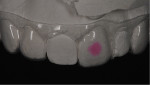 Fig 4. Non-scalloped, no-reservoir bleaching tray with pink mark on No. 9 and teeth molds of Nos. 8 and 10 cut out.
