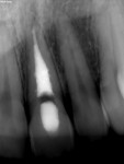 Fig 7. Completed NSRCT, tooth No. 9.