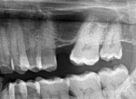 Fig 1. Radiograph showing 2 mm of crestal bone between the ridge and sinus floor.