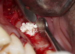 Fig 5. Osseous graft material being placed into the elevated sinus.