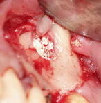 Fig 7. Additional osseous graft material placed into the sinus after implant placement to ensure a lack of voids around the portion of the implant within the sinus area.