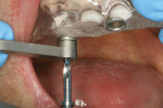 Figure 6  Surgical guide directs 2.2-mm pilot and 2.8-mm preparation burs to proper predetermined depth.