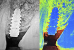 Fig 9. Immediate radiograph after implant placement and sinus augmentation. Right, image demonstrates bone density in relation to the implant surface.