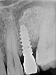 Fig 11. Radiograph of implant and graft 24 months after restoration showing good bone level at the crest and sinus graft.