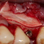 Fig 8. Porcine pericardial membrane placed over the osseous window of the sinus lift to prevent gingival ingrowth into the maturing sinus graft.