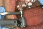 Figure 7  Surgical guide directs 2.2-mm pilot and 2.8-mm preparation burs to proper predetermined depth.