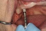 Figure 8  Straumann dental implant racheted to place.