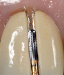 (4.) After a diamond bur was used to cut through the porcelain surface, a carbide fissure bur was used to section the metal alloy framework to remove the crown.
