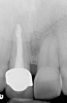 (3.) Preoperative periapical radiograph revealed poor interproximal marginal integrity of crown No. 8.