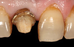 (5.) Discolored tooth No. 8 stump shade.