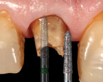 (6.) K-series diamond burs were used to prepare the remaining tooth structure. This diagrammatic image shows 135-degree angulation shoulder preparation finish line.