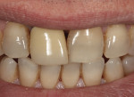 (1.) Preoperative extraoral smile view of patient with nonvital discolored maxillary right central incisor crown and tooth, which had received prior endodontic therapy.
