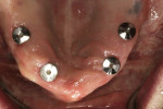 Figure 10  Four implants surgically placed in the maxillary arch.