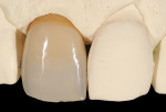 (12.) The definitive layered zirconia restoration was fabricated and fitted to the master solid cast.