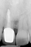 (15.) Postoperative periapical radiograph showing the satisfactory marginal fit of the new crown No. 8.