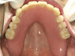 Figure 15  Complete denture seated firmly.