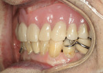 Figure 17  Complete denture seated firmly.