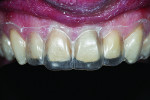 Fig 5 and Fig 6. Provisional matrix filled with acrylic placed in mouth.