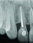 Fig 22 and Fig 23. One year later, an x-ray of tooth No. 10 showing external root resorption becoming more pronounced.