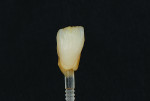 Fig 6. Restorations stained internally then freeze-fired.