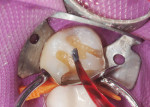 Figure 3  Flowable resin in a clear shade, brushed on the prepared tooth and along the margins.