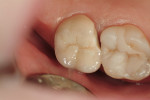 Figure 1  Failed zirconia restoration on the upper-right second molar.