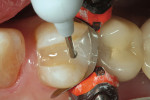 Figure 5  Surefil SDR was used to bulk-fill the cavity as a dentin replacement.