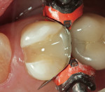 Figure 6  Note the self-leveling property of the dentin replacement prior to light-curing. The pulpal floor and proximal box were filled to the level of the proximal contact area and then light-cured.