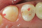 Figure 9: After final polishing with rubber abrasives, the occlusion was verified using articulation paper.