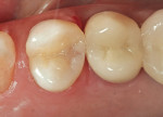 Figure 11  An occlusal view of the completed restoration of tooth No. 12 using a low-shrinkage flowable resin as a dentin replacement.