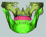 Fig 2. The digital information is processed
and composed symphonically to create an
accurate virtual dental patient, with both hard
and soft tissues, to start the multidisciplinary
workup with the restoring dentist, the
oral-maxillofacial surgeon, and the dental
technician at the GTM stage of the treatment
planning session.