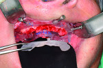Fig 8. The removable clear mock-up teeth are
removed, exposing the deformed alveolar bone
that was pre-planned for removal (osteotomy)
to accommodate the dental implants and final
prosthetics for strength and esthetics.