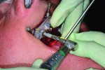 Fig 9. The dental implants are guided to depth,
trajectory, and rotation using the set of implant-guided surgical instruments.
