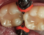 Figure 13  After etching and placement of adhesive resin, Surefil SDR was placed as a dentin replacement.