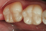 Figure 14  An occlusal view of the completed restorations after placement of microhybrid composite completed the enamel layer of the restoration.