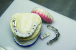 Fig 3. Diamart Implant Bridges from Panthera Dental.