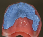 Fig 9. Bite registration material used to confirm there was no contact of the healing caps with the intaglio surface of the denture.