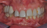 Fig 2. Supraeruption of anterior teeth created a deep bite of 6 mm.