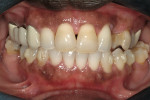 Figure 1  Postorthodontics of the maxillary jaw with correction of tooth No. 10 cross-bite and presentation to periodontist office. Orthodontics in the mandibular jaw was still in progress. A buccal concavity of tooth No. 11 can be seen in this view