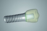 Fig 4. Provisional design based on the virtual position for the Straumann PURE Ceramic Implant. Note the software takes into account the abutment facets.