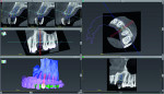 Fig 1. Virtual planning of a Straumann PURE Ceramic Implant for site No. 12 using implant planning software.
