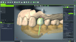 Fig 2. Restoration design for the No. 12 implant in the laboratory software.