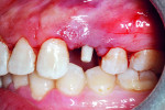 Fig 9. Final placement of Straumann PURE Ceramic Implant.